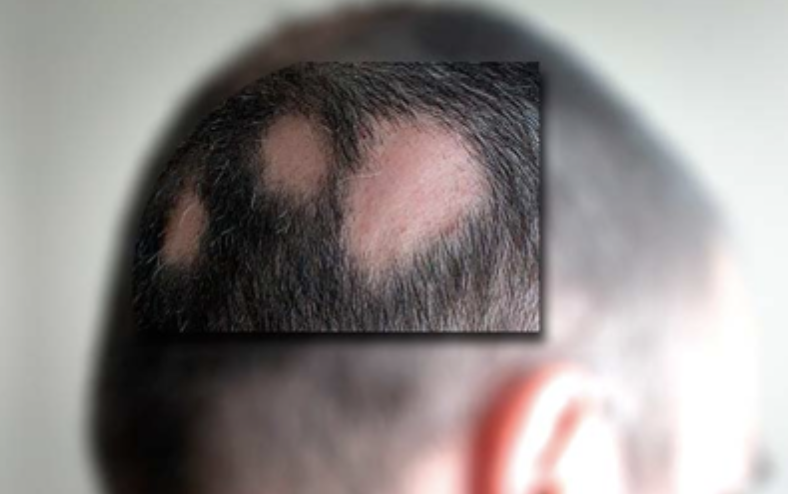 La FDA aprueba el primer tratamiento sistémico para la alopecia areata 
